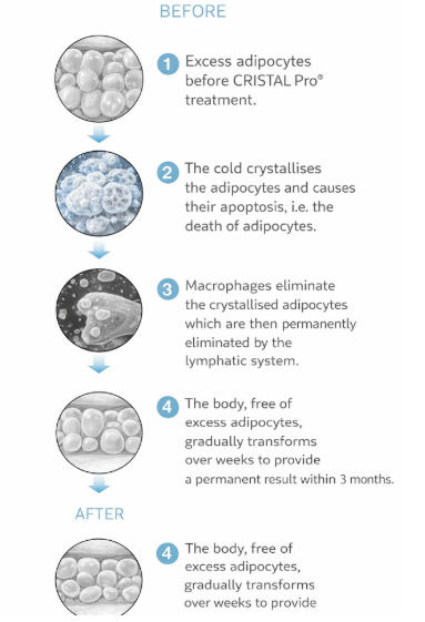 Treatment Process of Cristal Pro | Cristal Pro JB | Lyvin Clinic JB | Aesthetic Clinic Johor Bahru